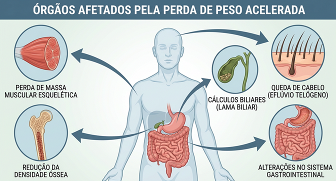 Órgãos afetados pela perda de peso acelerada: massa muscular, ossos, cabelo, vesícula e sistema gastrointestinal