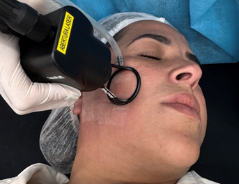 Procedimento estético com laser facial